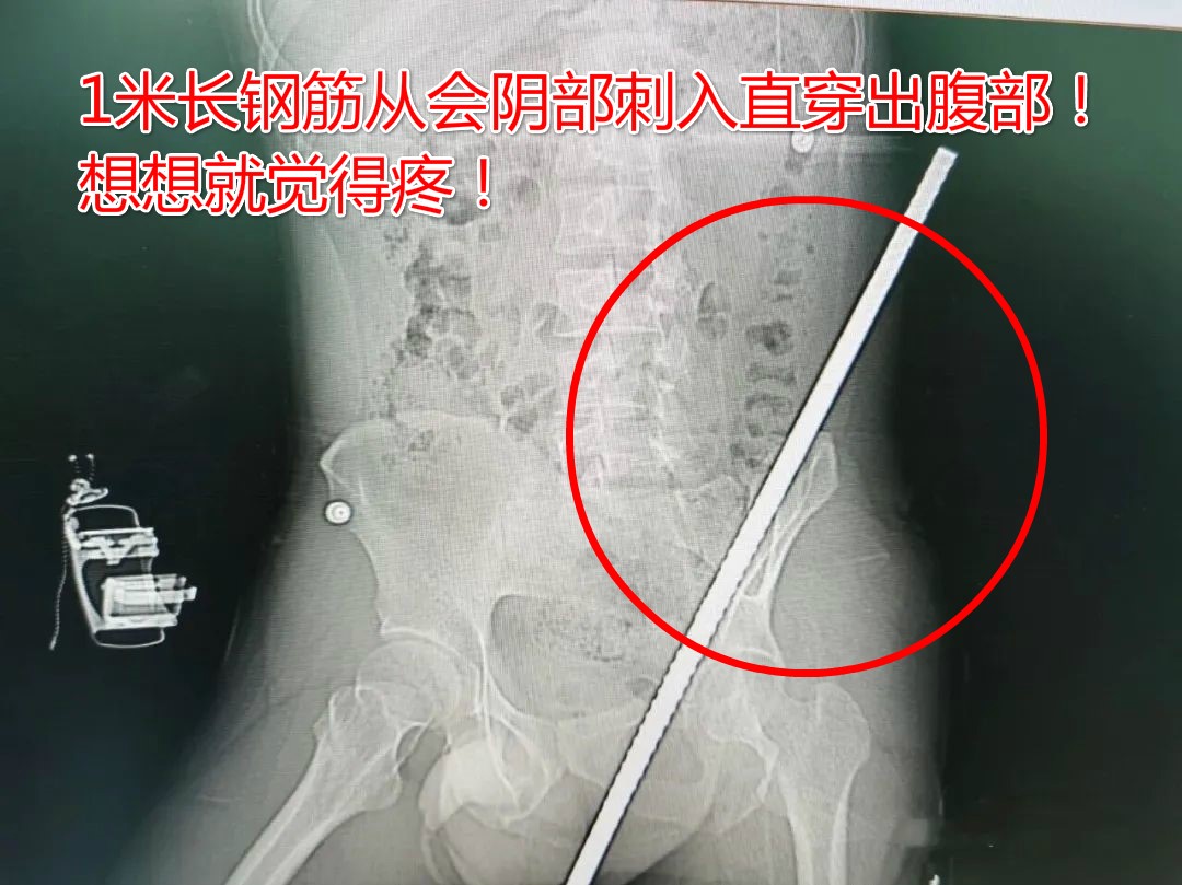 九死一生！一男子在西安某工地坠落，钢筋从会阴部刺入直穿出腹部！