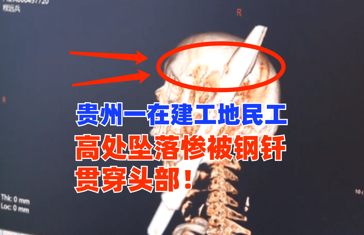 突发！7月中旬贵州一工地民工从高处意外坠落惨被钢钎贯穿头部！